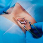Laser μυωπίας ή γυαλιά και φακοί επαφής; Πλεονεκτήματα και διαφορές