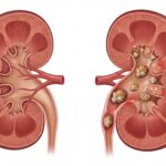 Types of Kidney Stones: How They Form and How They Are Treated